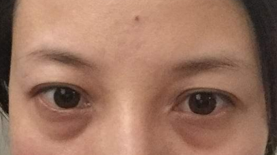 激光祛除眼袋有效嗎？激光祛眼袋有什么利弊？