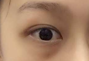 激光祛眼袋要多少錢？