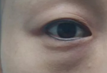 激光去眼袋可以管多久？