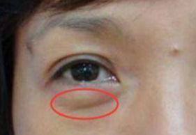 激光去眼袋可以管多久？激光祛眼袋多久可以恢復(fù)？