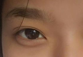 激光去眼袋后需多久能恢復(fù)？激光去眼袋快速有效嗎？