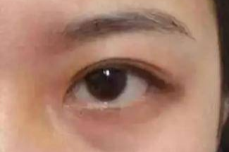 激光祛眼袋效果真的好嗎？激光去眼袋會(huì)有風(fēng)險(xiǎn)嗎？