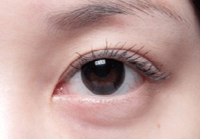 激光去眼袋會不會很疼？激光去眼袋什么人適合？
