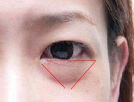 激光除眼袋效果如何？激光去眼袋要注意什么？