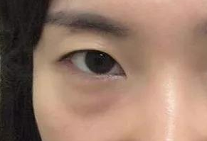 激光祛眼袋會(huì)疼嗎？激光去眼袋手術(shù)好嗎？