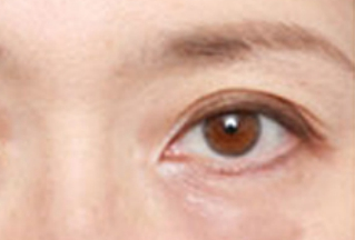 激光去眼袋幾天能恢復(fù)？激光去眼袋是怎樣的？