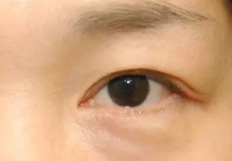 激光去眼袋術(shù)后會不會反彈？激光去眼袋術(shù)后注意事項？