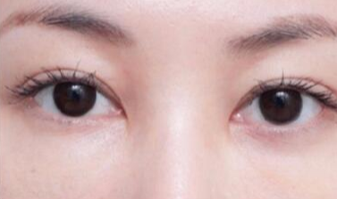 激光去眼袋術(shù)后注意事項(xiàng)有哪些？
