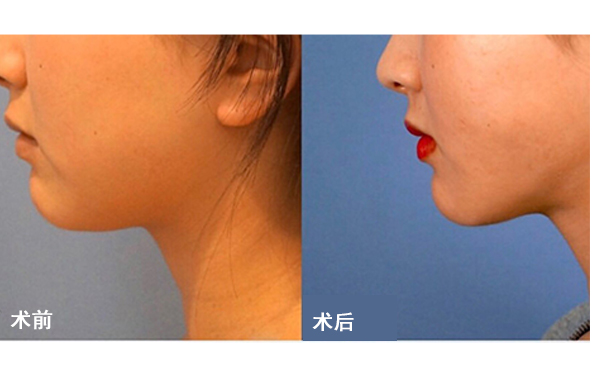 面部吸脂后皮膚會(huì)不會(huì)松弛？