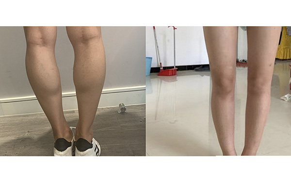 瘦腿針和吸脂哪個好？