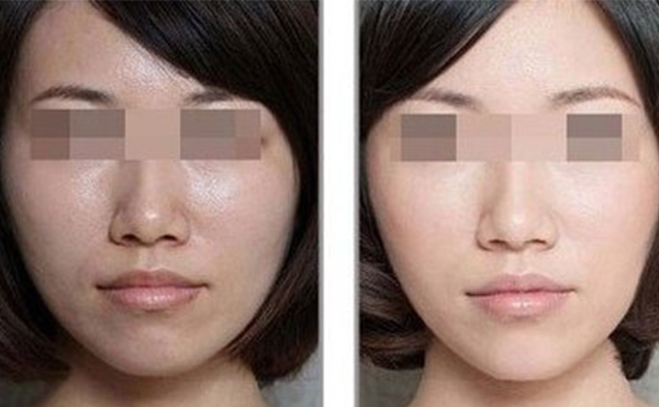美白針的效果怎么樣？