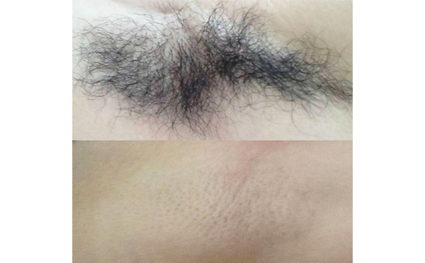 激光脫腋毛疼嗎？