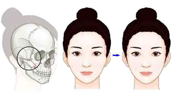 顴骨降低整形手術(shù)是怎么操作的？有什么特點(diǎn)？