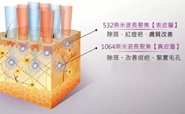 皮秒祛斑恢復(fù)期多久？