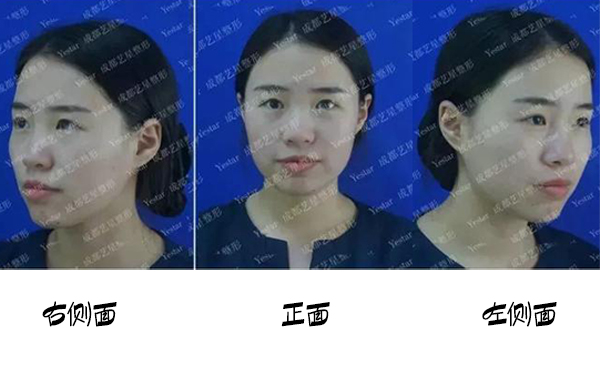 福州名韓整形改善蒜頭鼻大概要花多少錢？