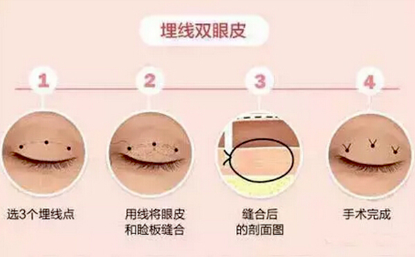 全切雙眼皮跟埋線的區(qū)別是什么？哪個(gè)好？