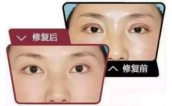 哪些情況需做雙眼皮修復(fù)？修復(fù)難度大不大?