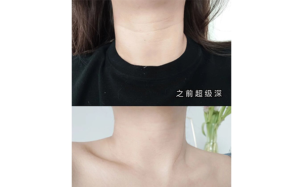 激光去頸紋適合哪些人？