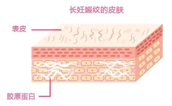 妊娠紋是怎么形成的？