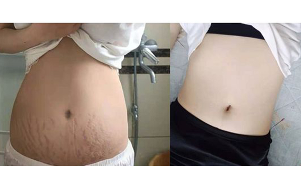 激光可以去除妊娠紋嗎？