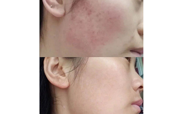 彩光嫩膚會(huì)讓皮膚變薄嗎？