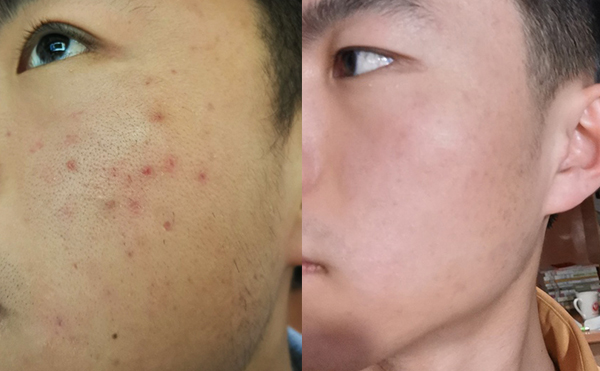 白瓷娃娃每次治療間隔多久？
