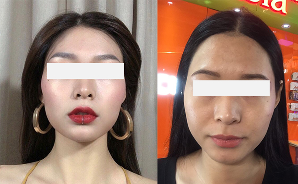 激光脫發(fā)際線效果怎么樣？