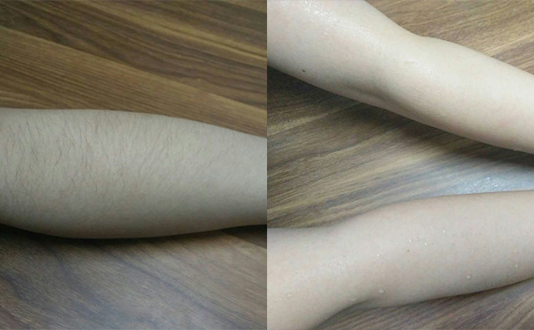 冰點(diǎn)手臂脫毛會(huì)傷害皮膚嗎？