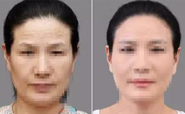 激光除皺有什么優(yōu)勢(shì)？