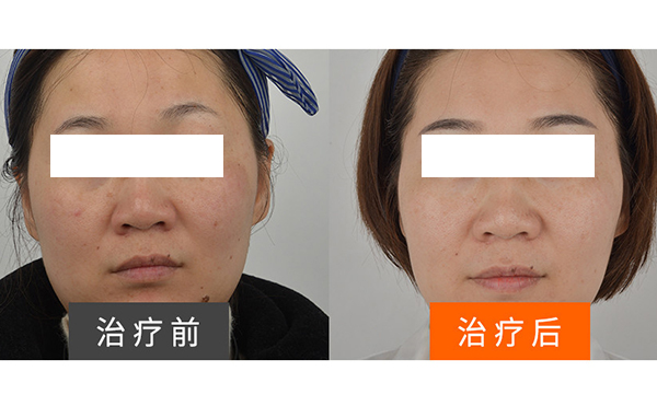彩光嫩膚安全不安全？
