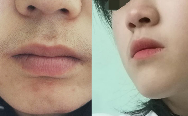 激光脫毛的效果怎么樣？