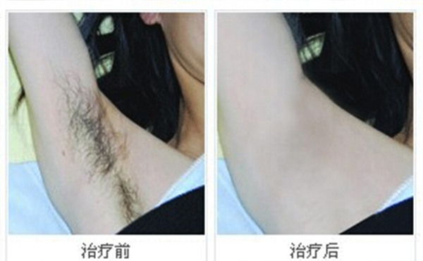 冰點脫腋毛安全嗎？