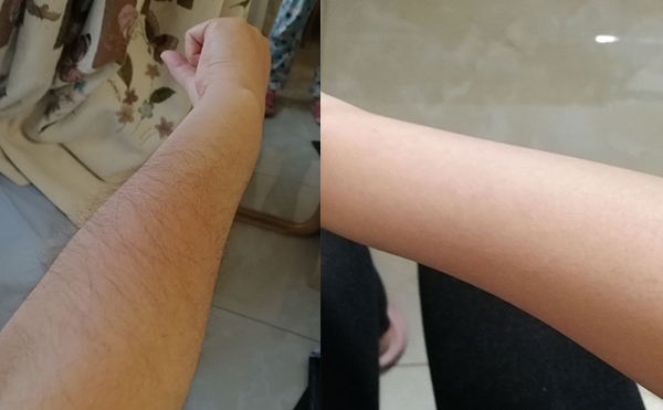 光子手臂脫毛幾次能脫完？