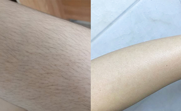 激光手臂脫毛安全嗎？