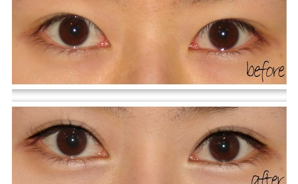 開(kāi)眼角手術(shù)有什么原則？