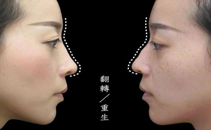 駝峰鼻矯正多少錢？駝峰鼻矯正有危險嗎？