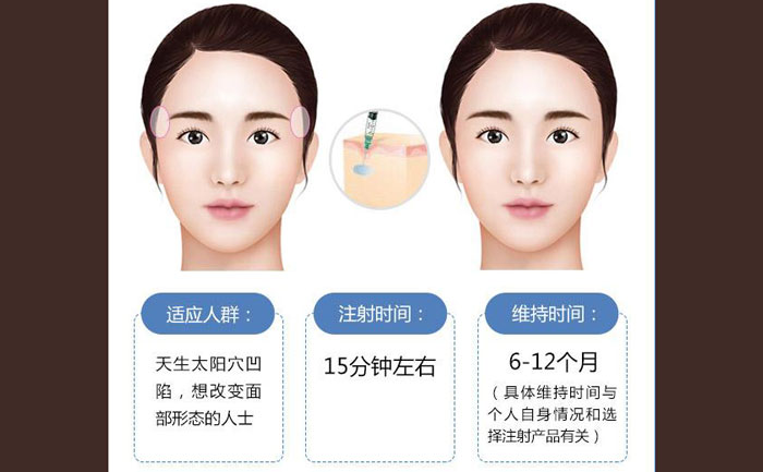 玻尿酸豐太陽穴一般幾支？