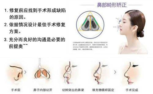 隆鼻修復效果怎么樣？