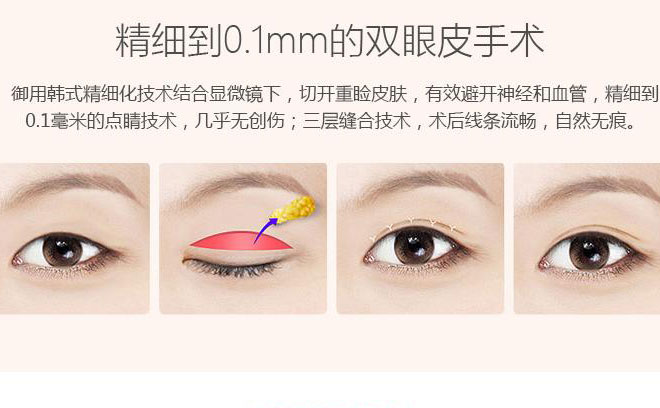 韓式三點(diǎn)雙眼皮一般要多少錢(qián)？