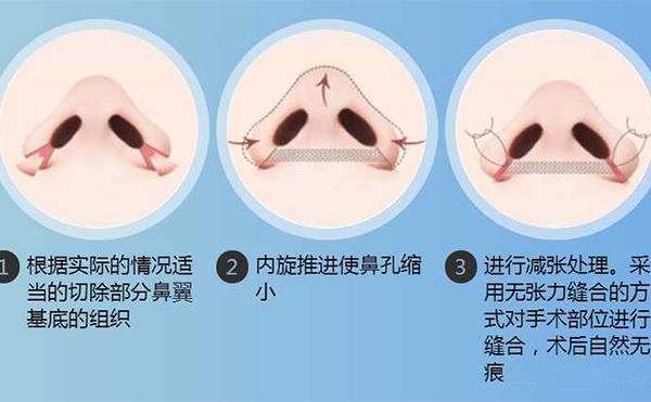 鼻翼縮小手術(shù)有用嗎？