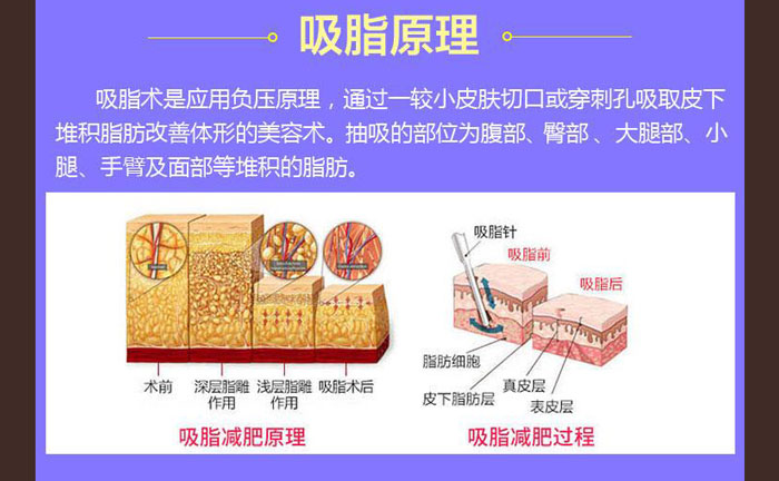 水動(dòng)力吸脂效果好嗎？