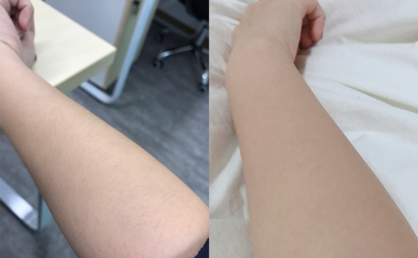 冰點脫毛有什么優(yōu)勢？