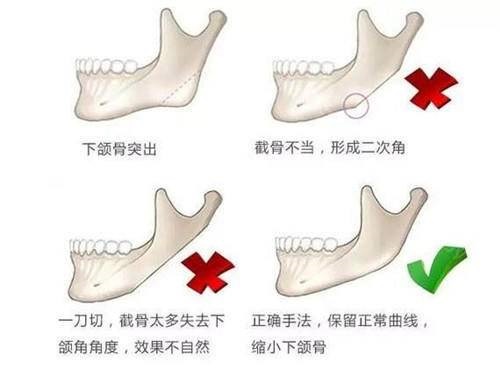 合肥藝星周海林醫(yī)生手術示意圖