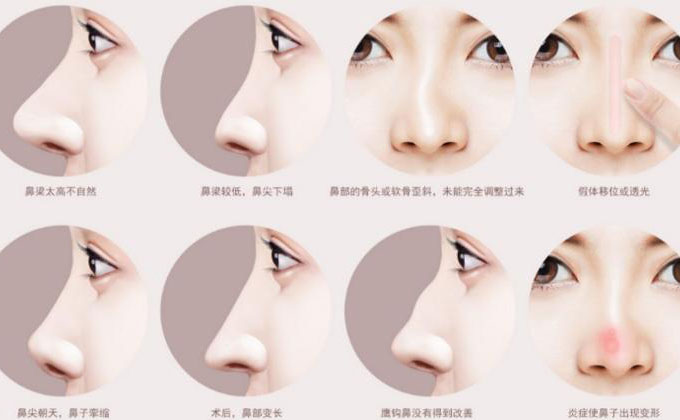鼻尖整形大概多少錢？