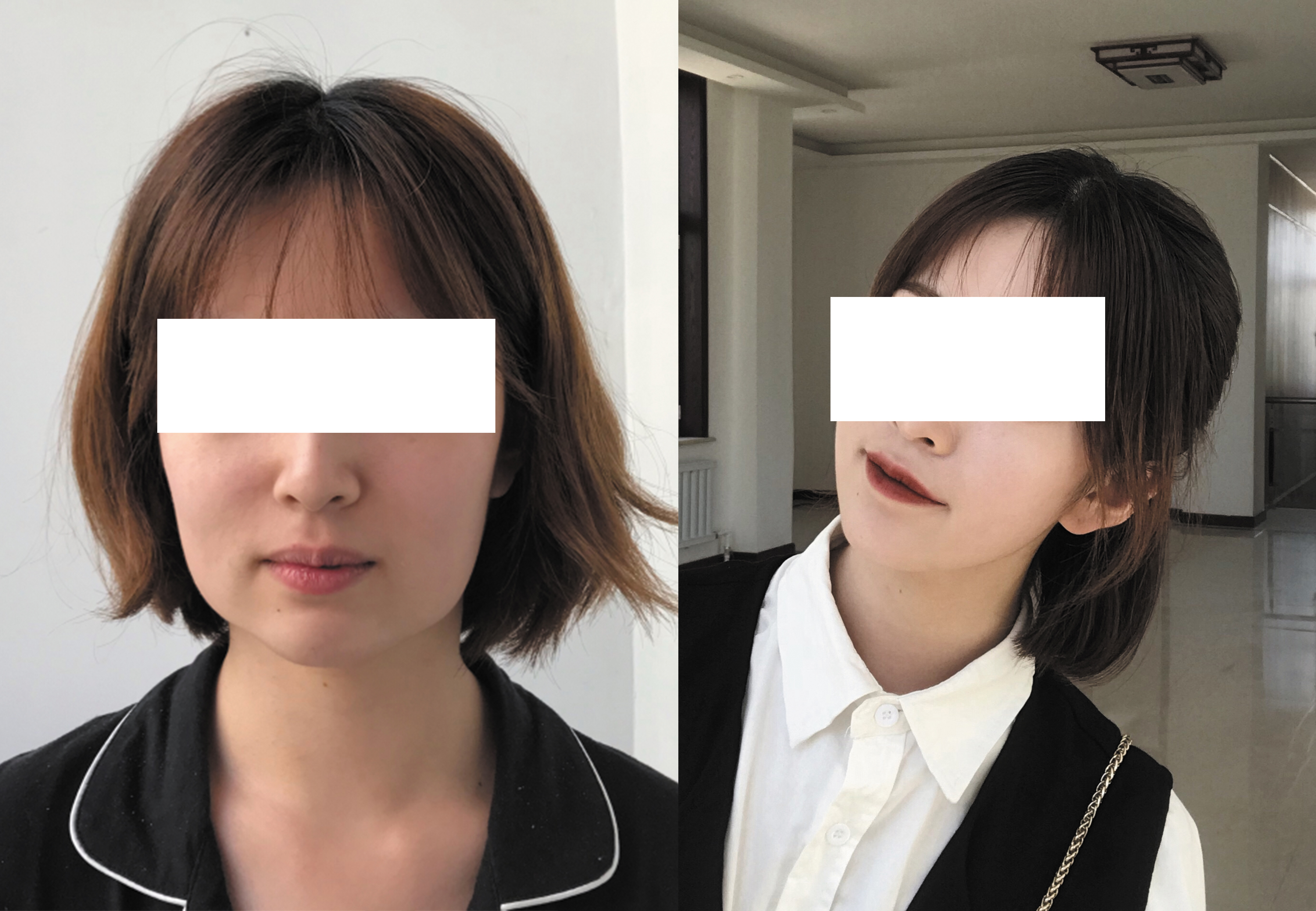 合肥藝星周海林醫(yī)生手術效果圖2