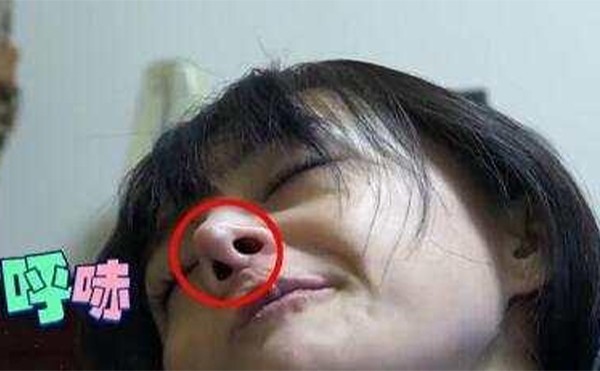 鼻假體取出后會變形嗎?能恢復原樣嗎?