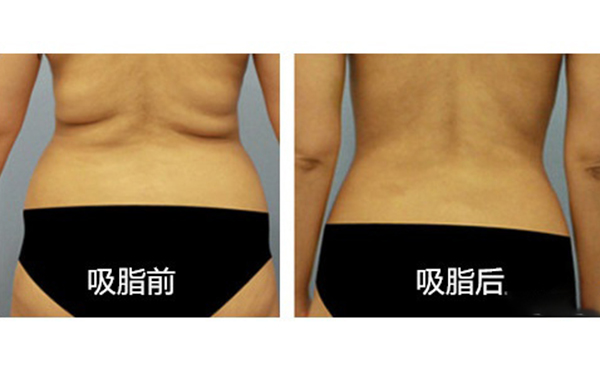 腹部吸脂需要多久恢復(fù)？