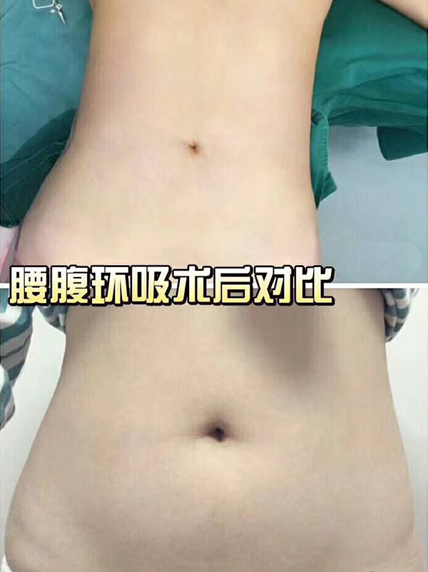 腰腹環(huán)吸術(shù)效果對(duì)比圖1