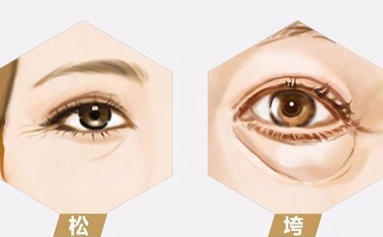 無(wú)痛去眼袋價(jià)格多少錢(qián)？