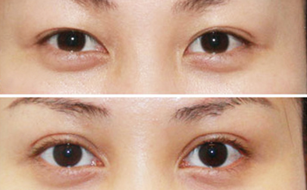內(nèi)雙做雙眼皮是什么價格？效果怎么樣？